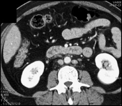 Duplicated Left Inferior Vena Cava (IVC) - CTisus CT Scan