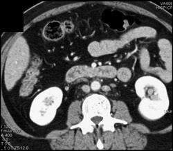 Inferior Vena Cava (IVC) on Left Simulates A Node - CTisus CT Scan