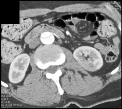 Aortic Dissection With Renal Infarction - CTisus CT Scan