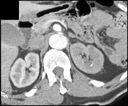 Renal Infarction and Dissection - CTisus CT Scan