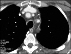 Takayasu's Arteritis - CTisus CT Scan