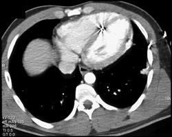 Bullet in Intraventricular Septum - CTisus CT Scan