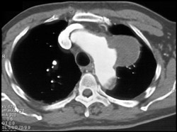 Pseudoaneurysm - CTisus CT Scan