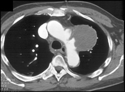 Pseudoaneurysm - CTisus CT Scan