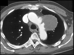 Pseudoaneurysm - CTisus CT Scan