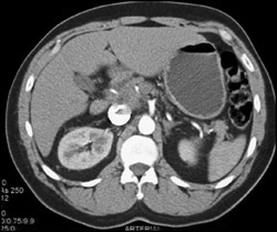 Flow Change With Fluid Contrast Level in PVC - CTisus CT Scan