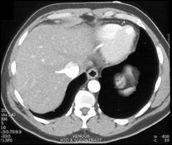 Normal Inferior Vena Cava (IVC) - CTisus CT Scan