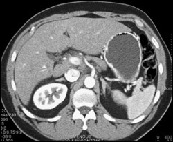 Normal Inferior Vena Cava (IVC) on Early Phase - CTisus CT Scan