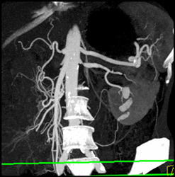 Renal Artery Stenosis - CTisus CT Scan