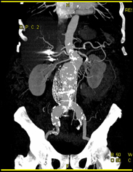 Renal Artery Stenosis and Abdominal Aortic Aneurysm (AAA) - CTisus CT Scan