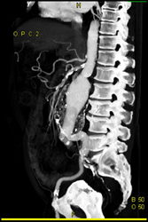 Abdominal Aortic Aneurysm (AAA) With Stenosis of Celiac Artery and SMA - CTisus CT Scan