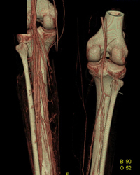 Ct Angiogram of the Lower Extremities - CTisus CT Scan