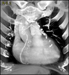 Classic Post-Coronary Artery Bypass Graft (CABG) CT Appearance - CTisus CT Scan