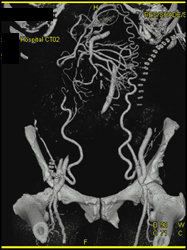 Subcutaneous Collaterals Due to Occluded Aorta - CTisus CT Scan