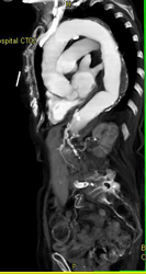 Aortic Aneurysm - CTisus CT Scan