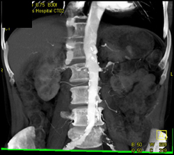 Stenosis of the Left Renal Artery - CTisus CT Scan