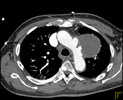 Pseudoaneurysm - CTisus CT Scan