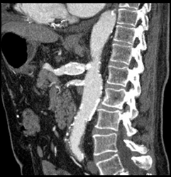 Celiac Artery Aneurysm - CTisus CT Scan