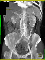 SMA Dissection - CTisus CT Scan