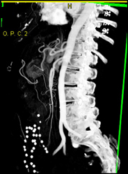 Dissection of SMA - CTisus CT Scan