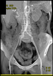 Stenosis of Both Proximal Iliac Arteries - CTisus CT Scan