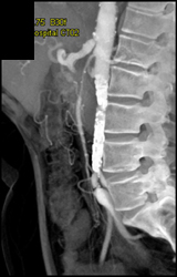 Narrowed SMA - CTisus CT Scan