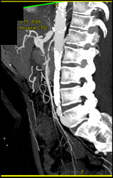 Narrowed SMA With Dilated Celiac Axis - CTisus CT Scan