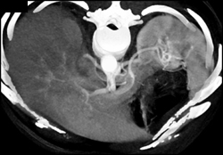 Celiac Artery Stenosis as Well as Aortic Dissection Involving SMA - CTisus CT Scan