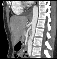 Dissection Involves the SMA - CTisus CT Scan