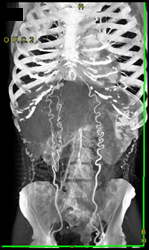 Abdominal Wall Collaterals - CTisus CT Scan