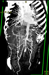 Occluded Abdominal Aorta - CTisus CT Scan