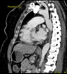 Dilated Descending Aorta - CTisus CT Scan