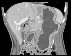 Gastroepiploic Veins - CTisus CT Scan