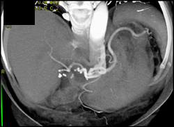 Hepatic Artery Stenosis - CTisus CT Scan