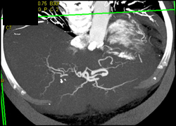 Hepatic Artery Stenosis- See Arrow - CTisus CT Scan