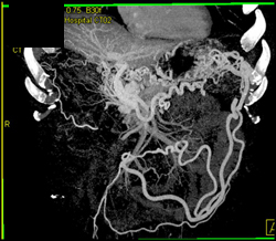 Cavernous Transformation of the Portal Vein With Collaterals - CTisus CT Scan