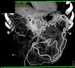 Incredible Collaterals Due to Portal Vein (PV) Occlusion - CTisus CT Scan