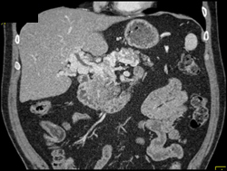 Cavernous Transformation of the Portal Vein - CTisus CT Scan