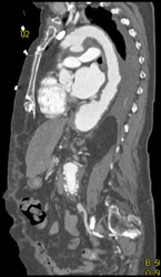 Aortic Aneurysm - CTisus CT Scan