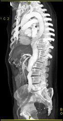 Aortic Aneurysm With Celiac Artery Stenosis - CTisus CT Scan