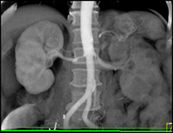 Prehilar Branching of Right Renal Artery - CTisus CT Scan