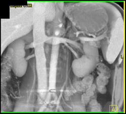 Bifid Left Renal Vein - CTisus CT Scan