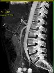 VRT and MIP of the Aorta - CTisus CT Scan