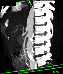 MIP and VRT of Plaque and Diseased Origins of Celiac Artery and SMA - CTisus CT Scan