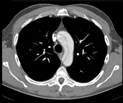 Aortic Dissection - CTisus CT Scan