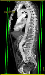 Pseudoaneurysm of Abdominal Aorta- See Next Case Also - CTisus CT Scan