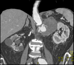 Pseudoaneurysm - CTisus CT Scan