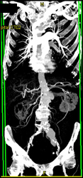 Pseudoaneurysm on MIP - CTisus CT Scan