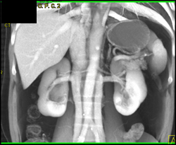 Duplicated Inferior Vena Cava (IVC) Beneath Renal Veins - CTisus CT Scan