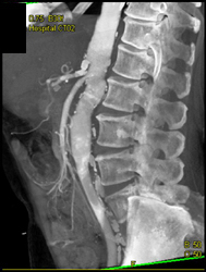 Fractured Stent in Celiac Artery - CTisus CT Scan